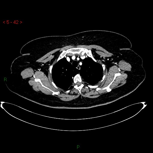 File:Azygos fissure and lobe (Radiopaedia 47620-52278 A 28).jpg