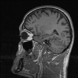 Balo concentric sclerosis (Radiopaedia 50458-55940 Sagittal T1 106).jpg