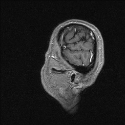 Balo concentric sclerosis (Radiopaedia 50458-55940 Sagittal T1 C+ 19).jpg