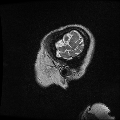 Balo concentric sclerosis (Radiopaedia 53875-59982 Sagittal 3D FSE 274).jpg