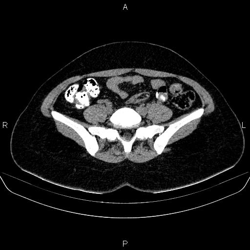 File:Bartholin gland cyst (Radiopaedia 62635-70930 Axial non-contrast 12).jpg