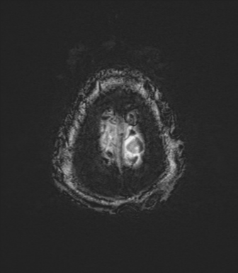 Basal ganglia metastasis (Radiopaedia 78928-91828 Axial SWI 86).png