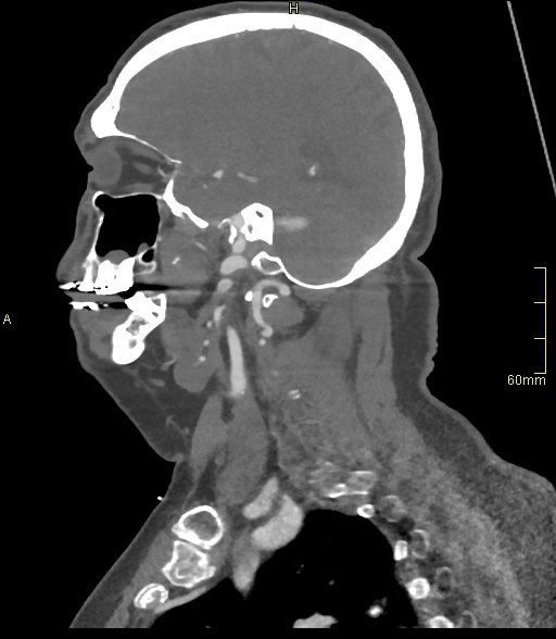 Basilar artery aneurysm (Radiopaedia 56261-62932 C 10).jpg