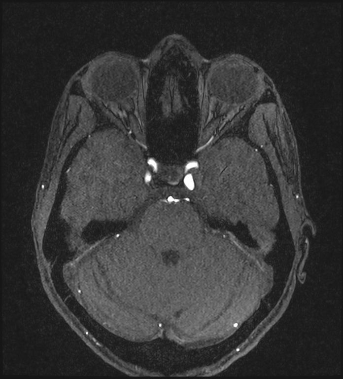 Basilar artery perforator aneurysm (Radiopaedia 82455-97733 Axial MRA 84).jpg