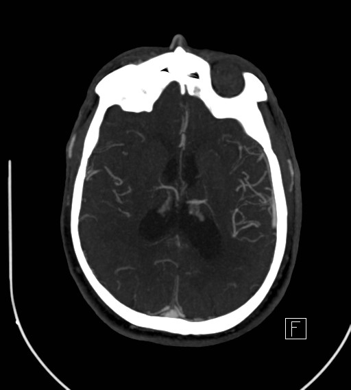 Basilar artery thrombosis (Radiopaedia 26986-27163 A 52).jpg