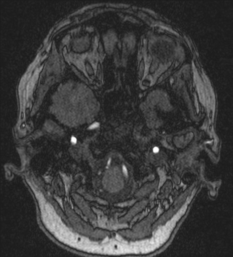 Basilar tip aneurysm (Radiopaedia 26504-26632 MRA 27).jpg