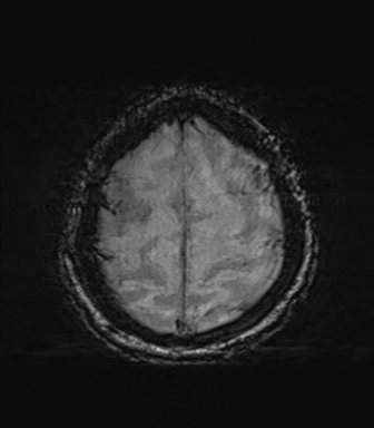 File:Behavioral variant frontotemporal dementia and late onset schizophrenia (Radiopaedia 52197-58083 Axial SWI 67).png