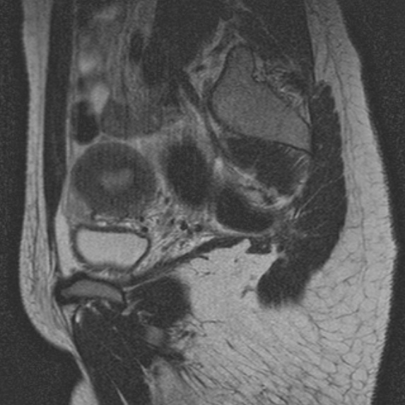File:Bicornuate uterus (Radiopaedia 24677-24949 B 3).jpg