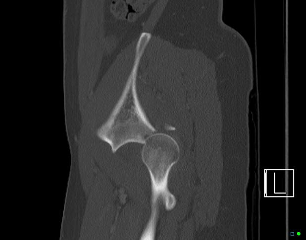 Bilateral acetabular fractures (Radiopaedia 79272-92308 Sagittal bone window 73).jpg