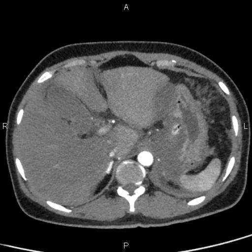 File:Bilateral adrenal gland hyperenhancement in pancreatitis (Radiopaedia 86642-102753 B 25).jpg
