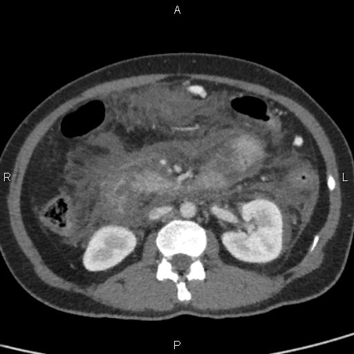 Bilateral adrenal gland hyperenhancement in pancreatitis (Radiopaedia 86642-102753 E 51).jpg