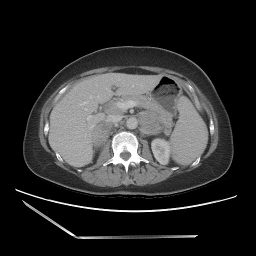 Bilateral adrenal granulocytic sarcomas (chloromas) (Radiopaedia 78375-91007 A 42).jpg