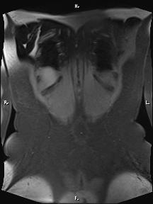 File:Bilateral adrenal myelolipoma (Radiopaedia 63058-71537 Coronal T1 fat sat 10).jpg