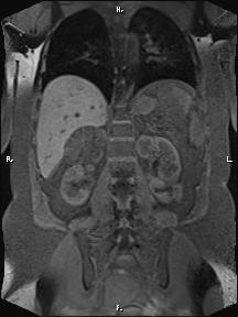 Bilateral adrenal myelolipoma (Radiopaedia 63058-71537 Coronal T1 fat sat 39).jpg