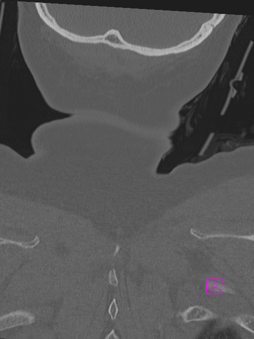 Bilateral atlanto-occipital assimilation (Radiopaedia 28350-28603 Coronal bone window 55).jpg