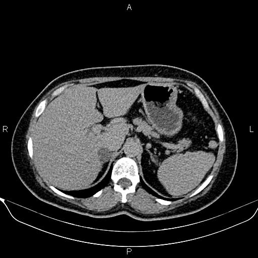 Bilateral benign adrenal adenomas (Radiopaedia 86912-103124 Axial C+ delayed 24).jpg