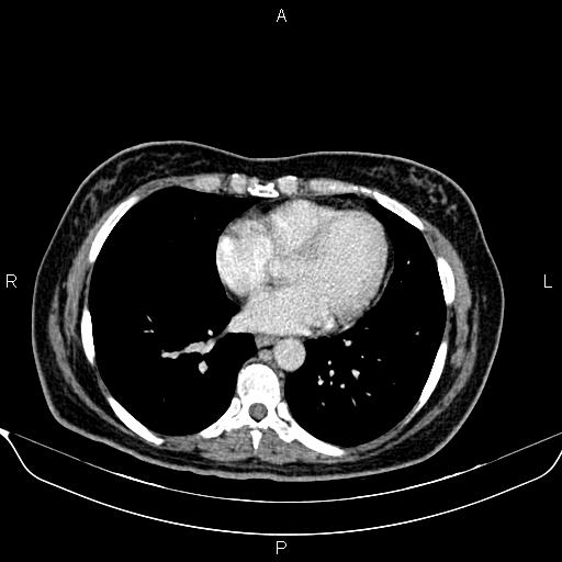 Bilateral benign adrenal adenomas (Radiopaedia 86912-103124 B 6).jpg