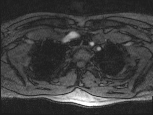 Bilateral carotid body tumors and right glomus jugulare tumor (Radiopaedia 20024-20060 Axial MRA 176).jpg