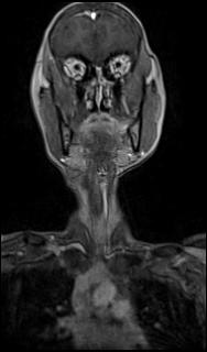 Bilateral carotid body tumors and right glomus jugulare tumor (Radiopaedia 20024-20060 MRA 6).jpg