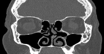 File:Bilateral ectopic infraorbital nerves (Radiopaedia 49006-54084 Coronal 39).png