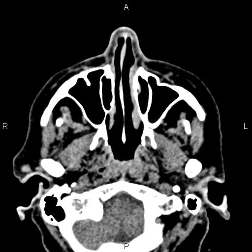 Bilateral enlargement of lacrimal glands - sarcoidosis (Radiopaedia 62627-70921 Axial non-contrast 9).jpg