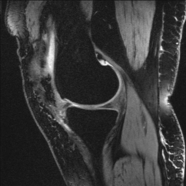 Bilateral focal pigmented villonodular synovitis (Radiopaedia 67643-77073 Sagittal T1 vibe 45).jpg