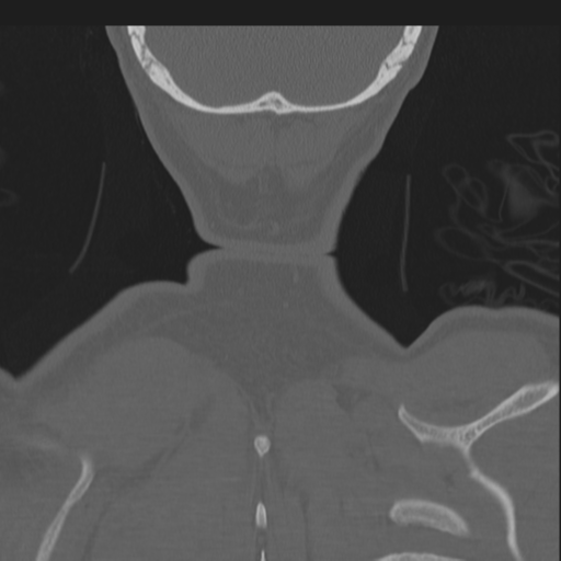 Bilateral locked facets (Radiopaedia 33850-35016 Coronal bone window 88).png