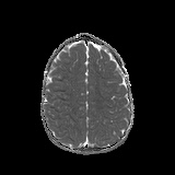 File:Bilateral mesial temporal polymicrogyria (Radiopaedia 76456-88181 Axial ADC 20).jpg