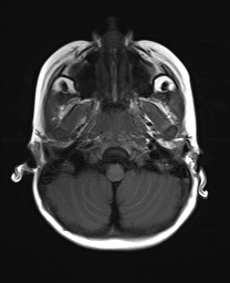 File:Bilateral mesial temporal polymicrogyria (Radiopaedia 76456-88181 Axial T1 3).jpg