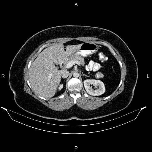 Bilateral ovarian dermoid cysts (Radiopaedia 85785-101603 A 36).jpg