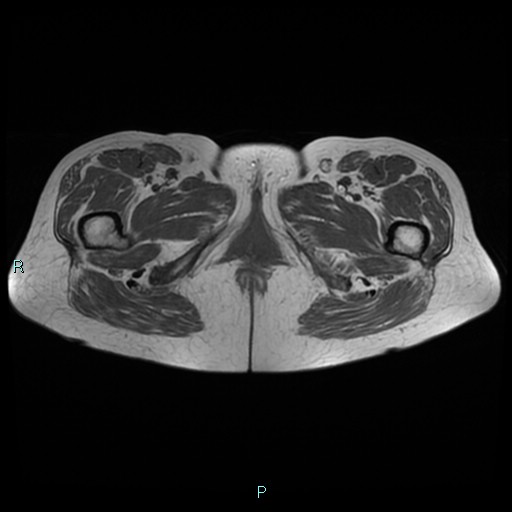 File:Bilateral ovarian fibroma (Radiopaedia 44568-48293 Axial T1 32).jpg