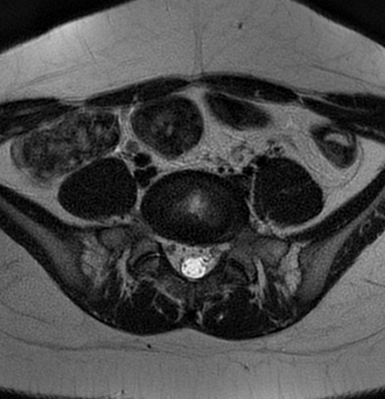 File:Bilateral ovarian fibrothecomas - adolescent (Radiopaedia 86604-102707 Axial T2 4).jpg