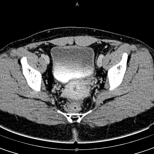 File:Bilateral ovarian teratoma (Radiopaedia 83131-97503 B 52).jpg