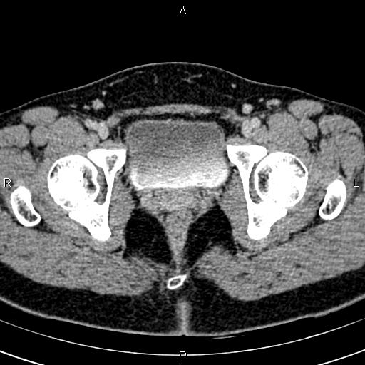 Bilateral ovarian teratoma (Radiopaedia 83131-97503 B 70).jpg