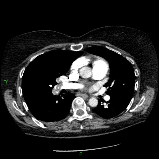 Bilateral pulmonary emboli (Radiopaedia 32700-33669 Axial C+ CTPA 54).jpg