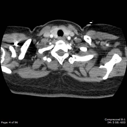 Bilateral pulmonary emboli with Hampton hump sign (Radiopaedia 54070-60246 Axial C+ CTPA 1).jpg
