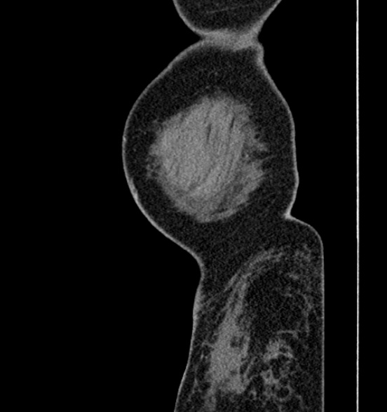 Bilateral rectus sheath hematomas (Radiopaedia 50778-56252 B 3).jpg