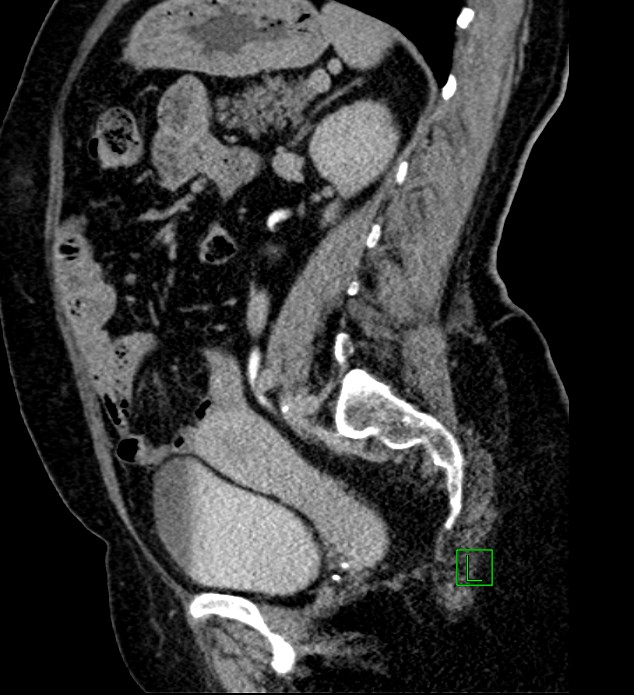Bilateral sporadic synchronous clear cell renal cell carcinoma (Radiopaedia 85035-100575 J 21).jpg