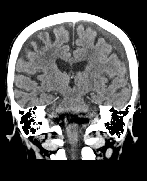 Bilateral subdural hygroma (Radiopaedia 73637-84421 Coronal non-contrast 29).jpg