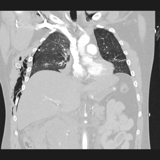 Bilateral traumatic renovascular injury (Radiopaedia 32051-32995 Coronal lung window 37).jpg