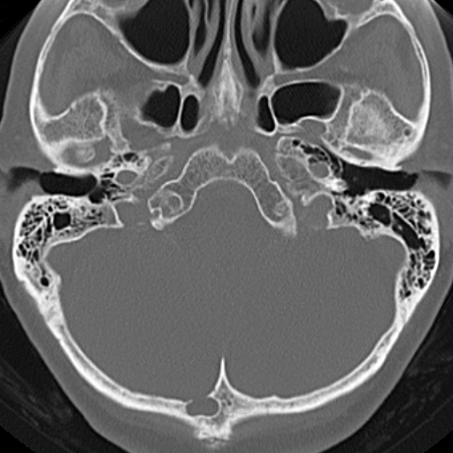 File:Bilateral tympanoplasty (Radiopaedia 16947-16664 Axial bone window 19).jpg