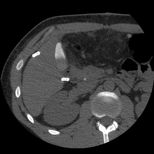 File:Bile leak from liver traumatic laceration (Radiopaedia 63463-72077 Axial Biliscopin 56).jpg