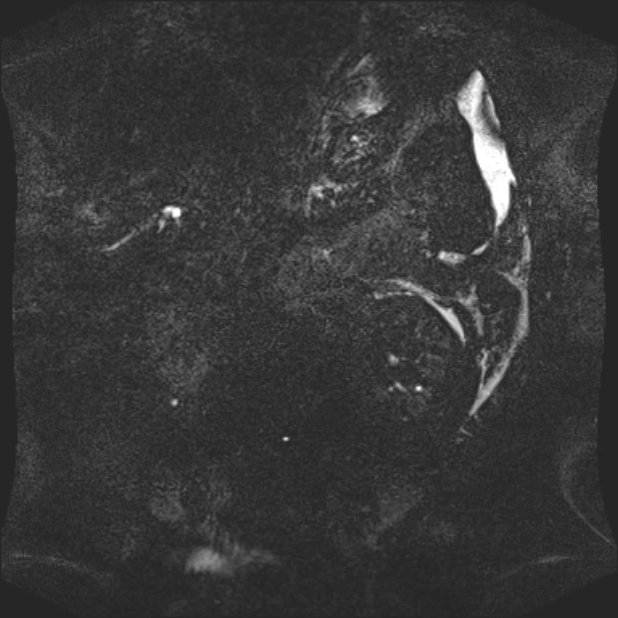 Biliary pancreatitis (Radiopaedia 72289-82824 Coronal 3D T2 88).jpg