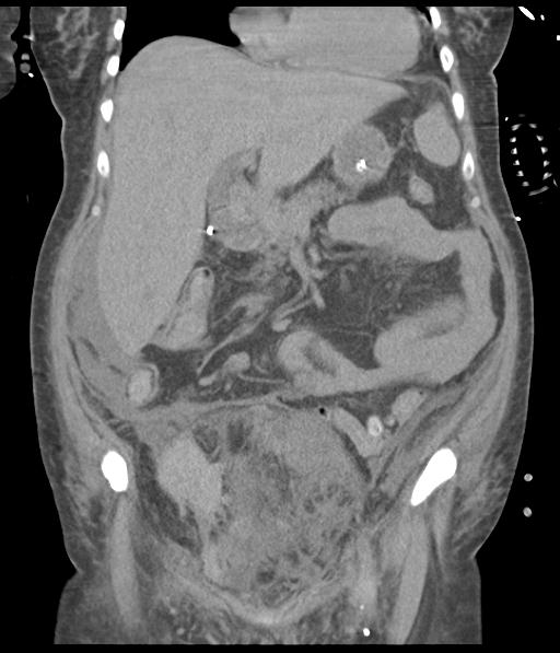 Bladder rupture post renal biopsy (Radiopaedia 30863-31572 Coronal non-contrast 25).jpg