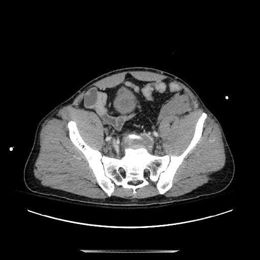 Blunt abdominal trauma with solid organ and musculoskelatal injury with active extravasation (Radiopaedia 68364-77895 A 122).jpg
