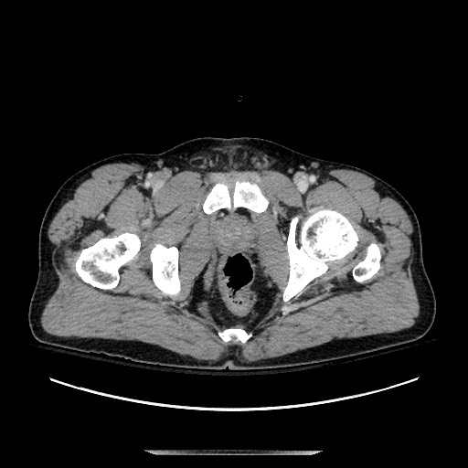 Blunt abdominal trauma with solid organ and musculoskelatal injury with active extravasation (Radiopaedia 68364-77895 A 155).jpg