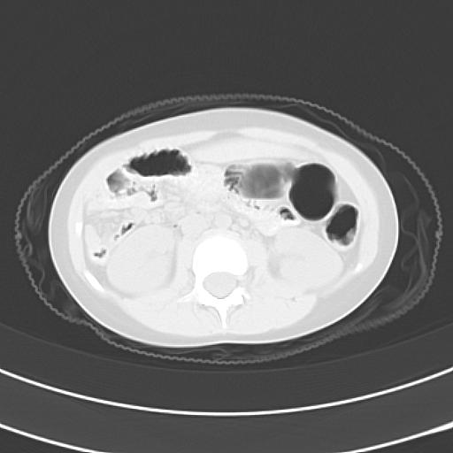 File:Bochdalek diaphragmatic hernia (Radiopaedia 38866-41059 Axial lung window 31).jpg