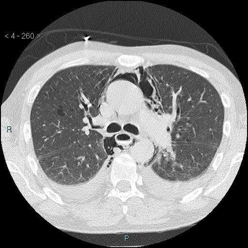 Boerhaave syndrome (Radiopaedia 27683-27897 lung window 18).jpg