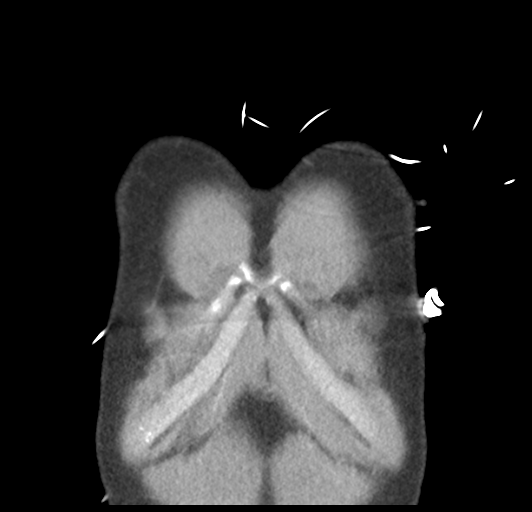 File:Boerhaave syndrome (Radiopaedia 39382-41661 B 6).png