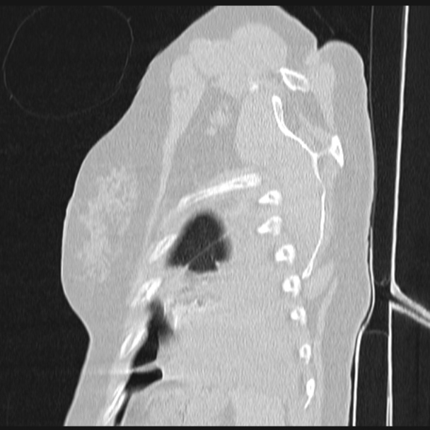Boerhaave syndrome (Radiopaedia 45644-49799 Sagittal lung window 78).jpg